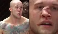 تصاویر وحشتناک از شکستگی بینی مبارز MMA