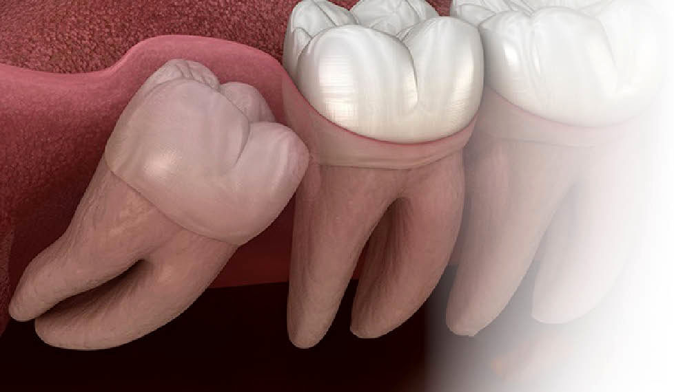 مراقبت‌‌‌های لازم پس از کشیدن دندان عقل