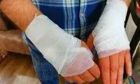 باورهای غلط درباره سوختگی