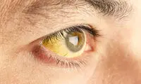 هشدار! هیپاتیت در کمین شماست، کبد را دریابید