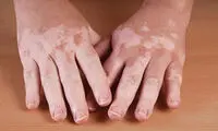 چه كسانی به پيسی مبتلا می‌شوند؟