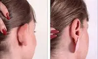  جراحی زیبایی گوش (اتوپلاستی) چیست و چگونه انجام می شود؟