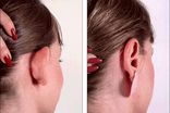 جراحی زیبایی گوش یا اتوپلاستی