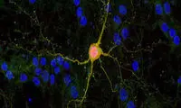 خبر خوش برای بیماران دارای عارضه‌ مغزی