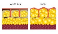 سلولیت پشت ران؛ چند راهکار ساده برای رفع آن