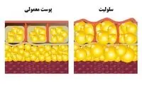 سلولیت پشت ران؛ چند راهکار ساده برای رفع آن