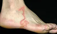 کرم‌هایی که زیر پوست راه می‌روند +عکس