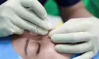 لیفت بینی با نخ | ماندگاری، عوارض و هزینه اصلاح فرم بینی با نخ