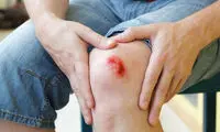 ۹ علامت عفونت و آلودگی زخم که باید جدی بگیرید