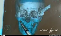 دو ساعت رانندگی با چاقویی در سر +عکس