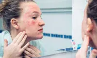 با اگزمای زمستانی چه کنیم؟