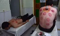 حجامت سرطان را درمان می کند؟