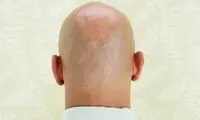 به انگشتانتان نگاه کنید تا مشخص شود طاس می‌شوید یا نه!