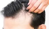 تاثیر استرس در بروز بیماری‌های پوست و مو
