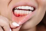جایگزین طبیعی آنتی‌بیوتیک برای درمان بیماری لثه