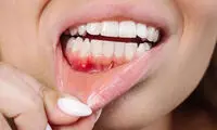 جایگزین طبیعی آنتی‌بیوتیک برای درمان بیماری لثه