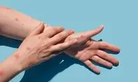 چرا آبله میمونی جهان را نگران کرده است؟
