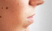 نخستین نشانه‌ها از سرطان پوست ‌