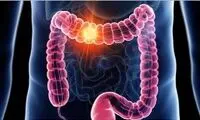 اقدامات پیشگیرانه برای مقابله با سرطان روده بزرگ