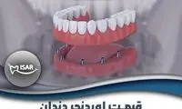 قیمت اوردنچر دندان در سال ۱۴۰۴ | معرفی کامل + جدول قیمت