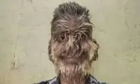تصاویری غیرمنتظره از پسر مبتلا به سندروم گرگینه