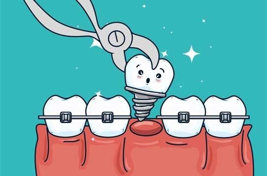 آیا دندان ایمپلنت شده را میتوان ارتودنسی کرد؟