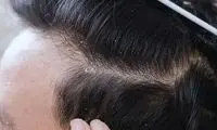 تغذیه چگونه بر شوره سر اثر می‌گذارد؟