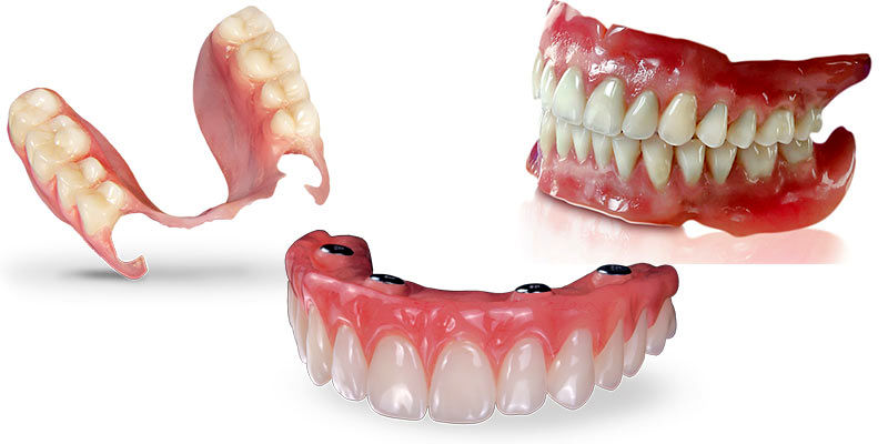 قیمت دندان مصنوعی ثابت بر پایه ایمپلنت چقدر است؟