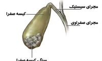 علائمی که نشان می‌دهد کیسه صفرای شما مشکل دارد