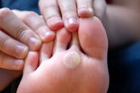 علت میخچه زدن پا چیست؟ + راهکارهای درمانی