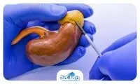 بیماری آدیسون یا Addison Disease چیست؟