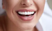 لمینت چهار دندان جلو چگونه انجام می ‌شود؟