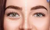 پیشنهادهایی برای برطرف شدن تیرگی و پف زیر چشم