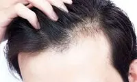 با کمبود این ویتامین‌ها دچار ریزش مو می‌شوید