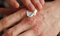 چگونه از خشکی پوست در روزهای سرد جلوگیری کنیم؟