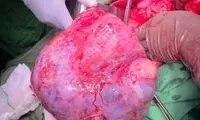 خارج کردن توده ۲۰ سانتی از شکم زن نیشابوری