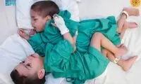 تصاویر تازه از جداسازی دوقلوهای خبرساز 