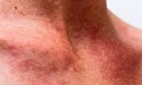تسکین فوری عرق‌سوز با ۵ روش ساده خانگی 