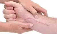 برای از بین بردن جای زخم‌ چه کنیم؟