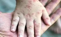 شناسایی ۷۰ مبتلا به سرخک در هرمزگان