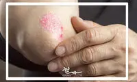پسوریازیس چیست و چگونه درمان می‌شود؟