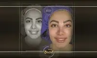 قبل از عمل بینی این ۷ نکته را حتما بخوانید!
