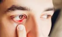 گل مژه چیست و چگونه باید آن را درمان کرد؟