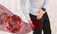 لخته شدن خون در پا چه خطراتی دارد؟ از عوارض مزمن تا مرگ ناگهانی