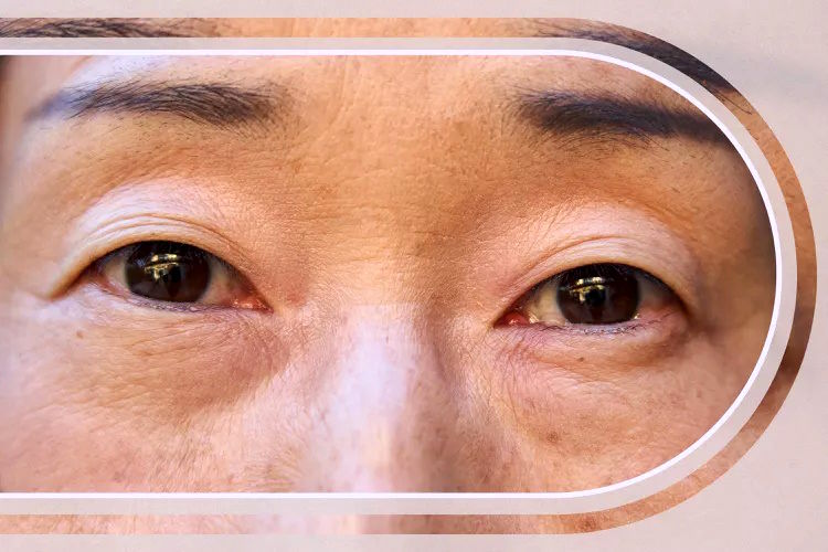بهترین روش‌ها برای درمان چروک‌های دور چشم
