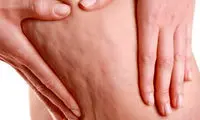 چند ترفند ساده برای کاهش سلولیت در خانه