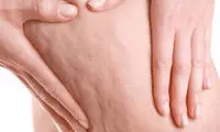 چند ترفند ساده برای کاهش سلولیت در خانه
