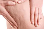 چند ترفند ساده برای کاهش سلولیت در خانه