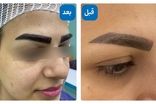 بهترین روش کاشت ابرو کدام است؟ | ماندگاری، مزایا، معایب و هزینه