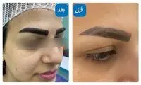 بهترین روش کاشت ابرو کدام است؟ | ماندگاری، مزایا، معایب و هزینه